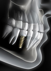 Diagram of an integrated dental implant in Jonesboro
