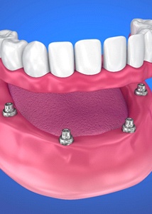 Diagram of implant dentures in Jonesboro