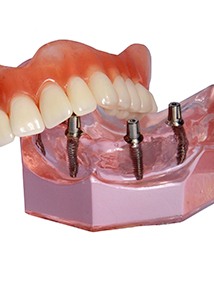 Model smile and full denture