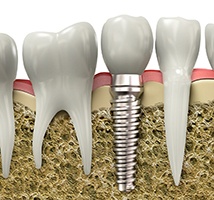 Diagram of dental implant in Jonesboro integrated in the bone