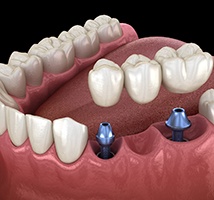 Diagram of a bridge hovering over dental implants in Jonesboro