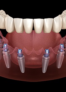 Digital illustration of implant dentures