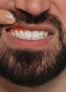 Man lifting his lip to show red, inflamed gums