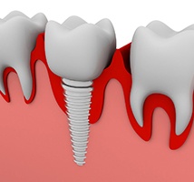Single dental implant in Jonesboro, AZ in jaw
