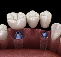 Bridge being attached to dental implants in Jonesboro, AR