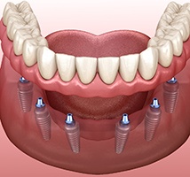 Full denture being attached to dental implants in Jonesboro, AR