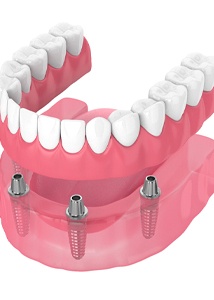 Illustration of implant-retained dentures in Jonesboro against white background