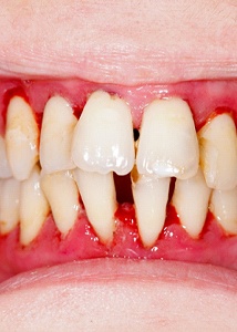 Mouth with advanced stages of gum disease.