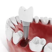 single tooth implant