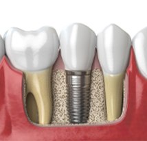 model of dental implant
