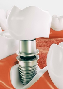 dental implant