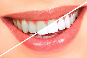 Teeth whitening before and after