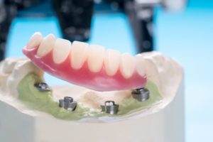 diagram of implant-retained dentures in jonesboro