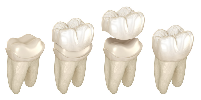 3D illustration of same-day dental crowns