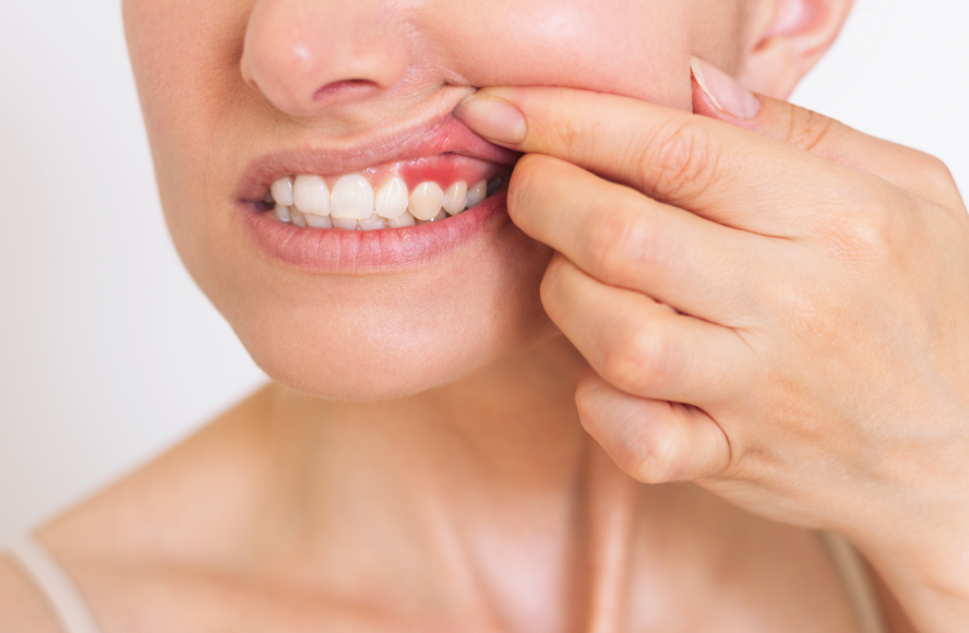 Close up of woman's mouth with inflamed gums